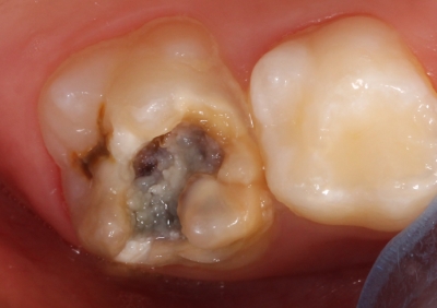 hipomineralizacion incisivo molar severo