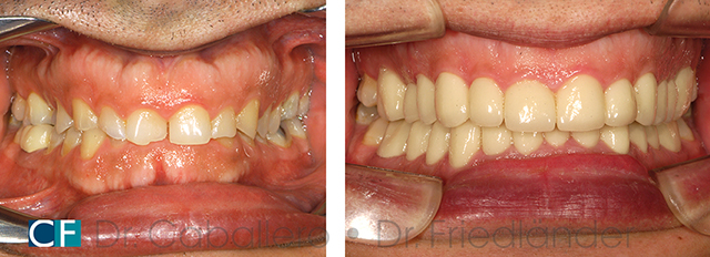 desgastes dentales antes y despues