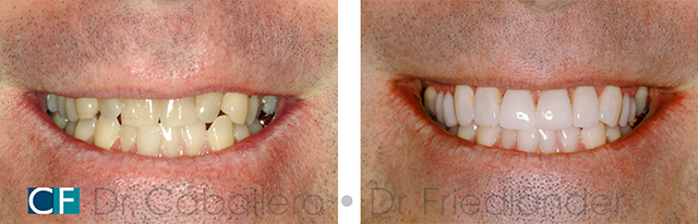 dientes-mas-blancos_antes-y-despues_clinica-dental-CF-Barcelona