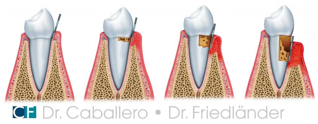 tratamiento periodontitis o enfermedad de las encias