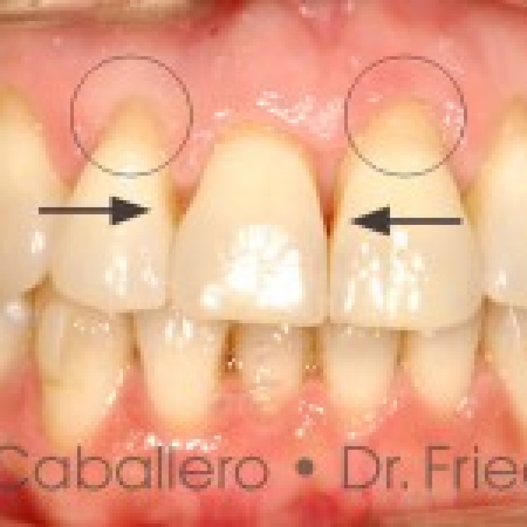 carillas esteticas recesion gingival antes