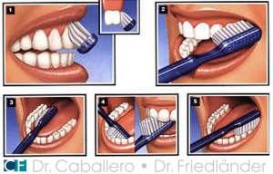 La higiene bucal en las recesiones gingivales