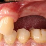 La pérdida de hueso en las extracciones de dientes