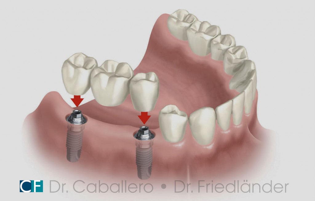 carga-inmediata_clinica-dental-CF-Barcelona-1024x655