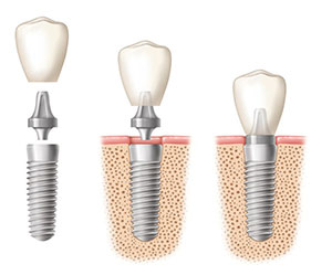 procedimiento-implante-dental