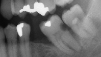 perdida-dental-caries
