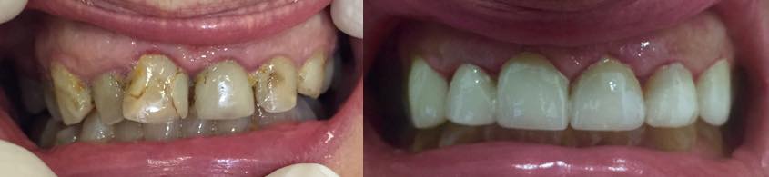 carillas dentales tratamiento ortodoncia