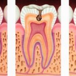 caries en los dientes