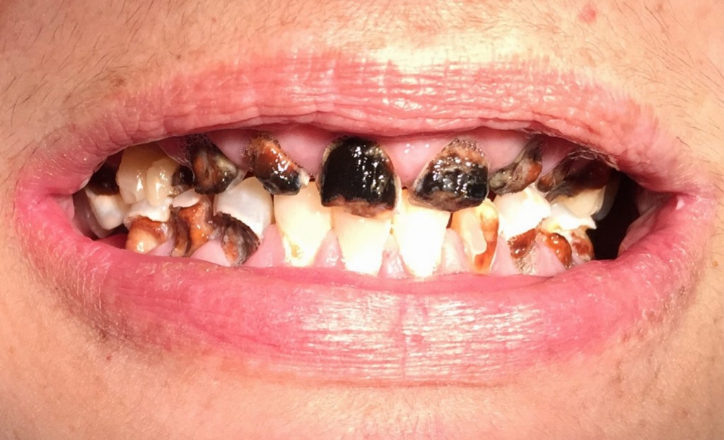 tratamiento-de-las-caries