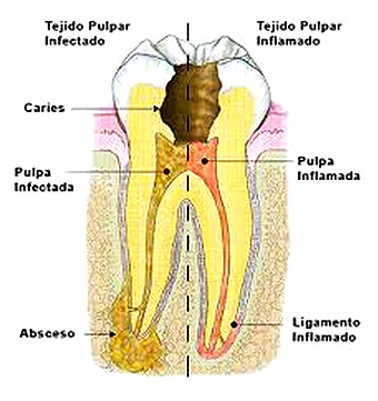 endodoncia