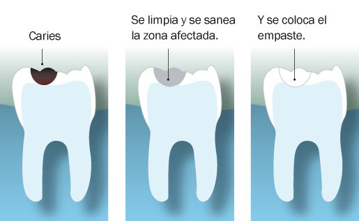 ¿Qué es un empaste dental y cómo se hace?