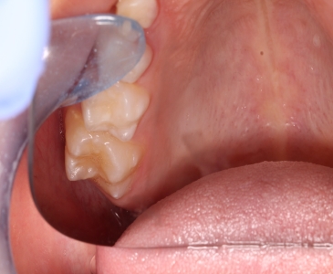 hipomineralizacion incisivo molar leve