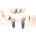 Tipos de implantes dentales