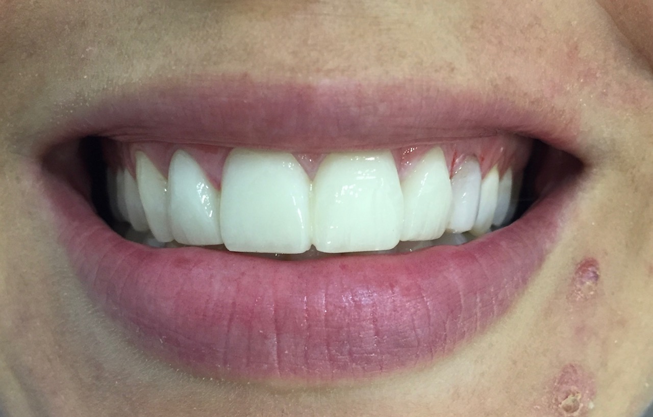 caso dental carillas lumineers