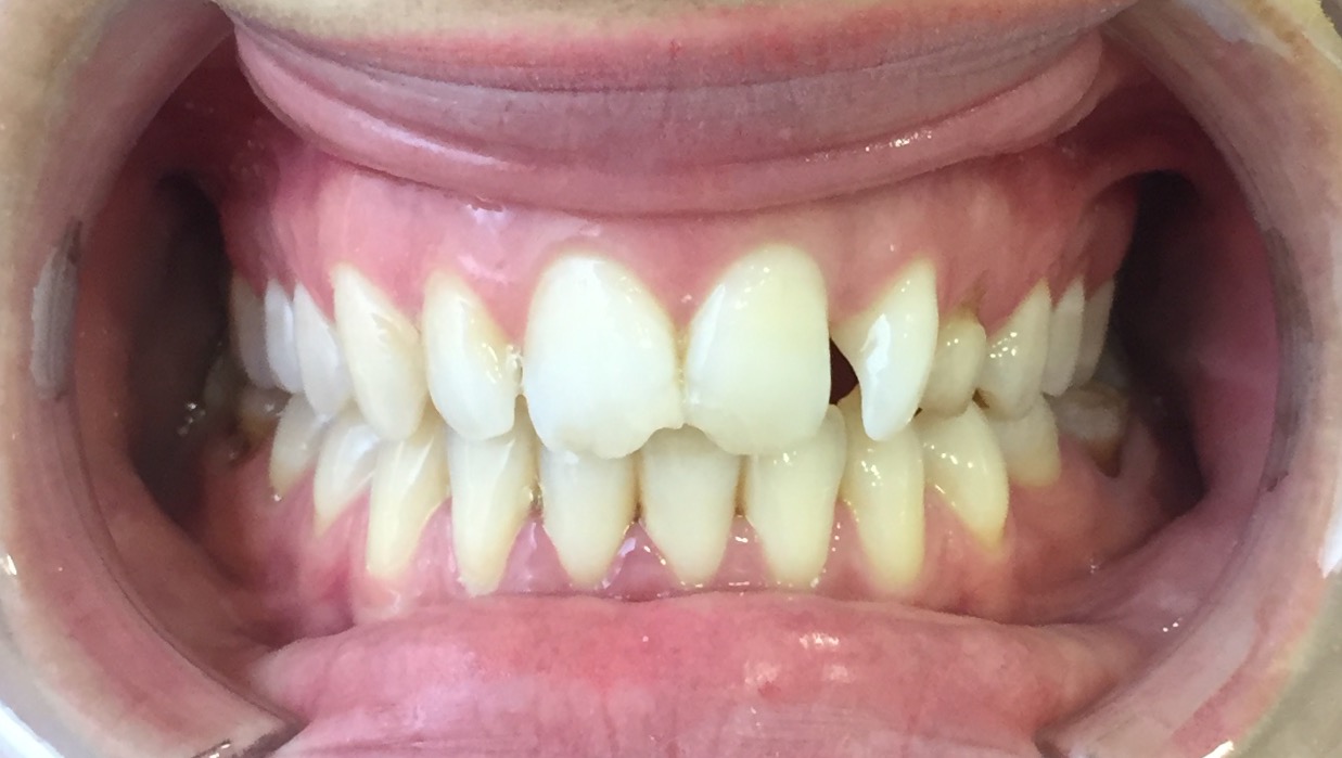 caso dental malposicion incisivos laterales