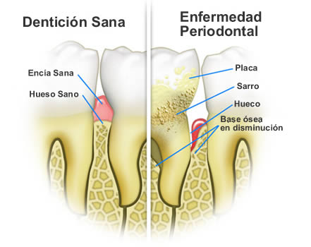enfermedad periodontal