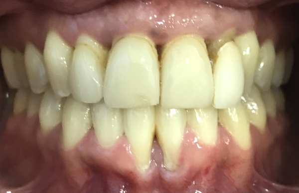 periodontitis y gingivitis