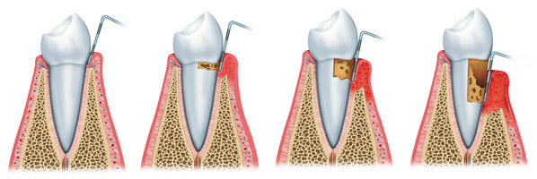 periodontitis