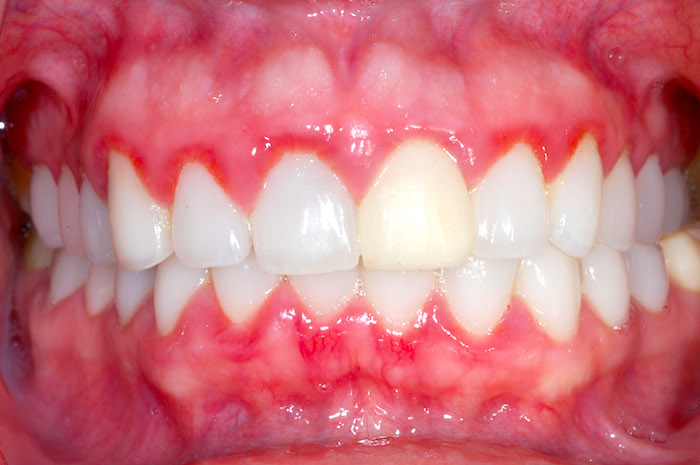 remedio casero para la gingivitis