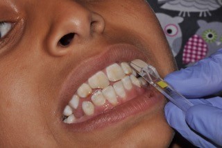 restauracion de composite en niños