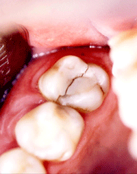 fractura de diente vertical