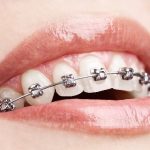¿Qué es la ortodoncia? Tipos de aparatos
