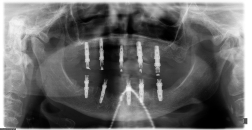 radiografía de implantes de dientes