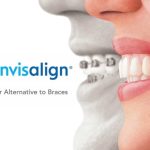 ¿Qué es Invisalign? Alternativa a los brackets