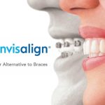 que es invisalign