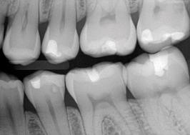 radiografia interproximal o aleta de mordida