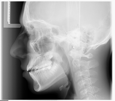 radiografia dental lateral