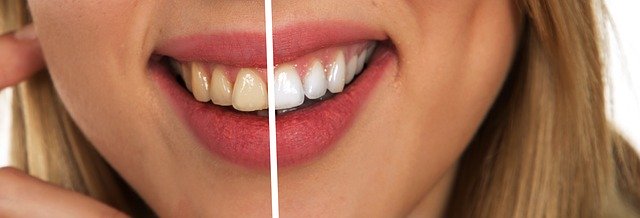 Cuanto Cuesta Una Limpieza Dental Precios Y Presupuesto