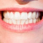 Blanqueamiento dental con la Lámpara Philips Zoom