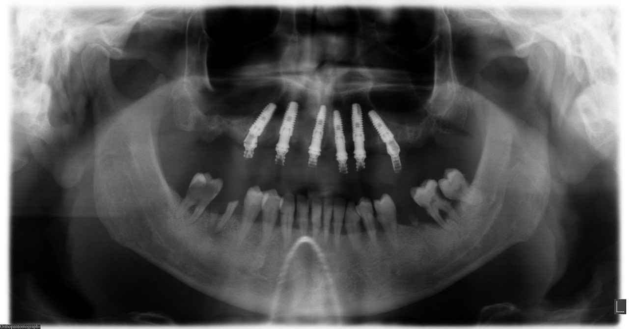 implantes-arcada-superior