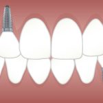 ¿Qué son los implantes dentales? ¿Cuál es la mejor opción?