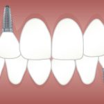 implantes-dentales