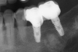 implantes-molares