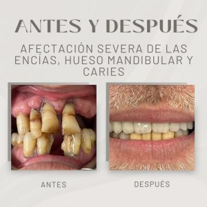 afectación severa de las encías, hueso mandibular y caries