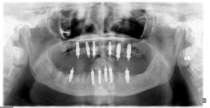 IMPLANTES con CARGA INMEDIATA