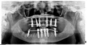 IMPLANTES con CARGA INMEDIATA