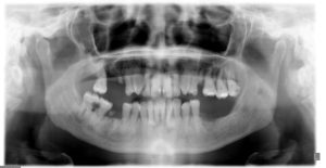 IMPLANTES con CARGA INMEDIATA