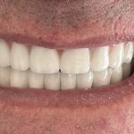 IMPLANTES con CARGA INMEDIATA
