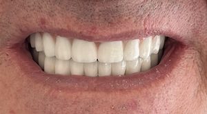 IMPLANTES con CARGA INMEDIATA